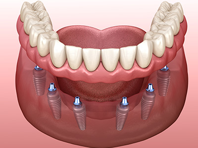 Dental implants Aurora