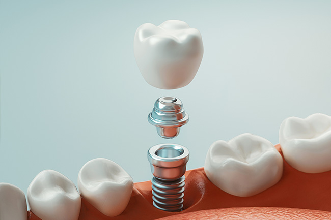 Dental implants West Chicago
